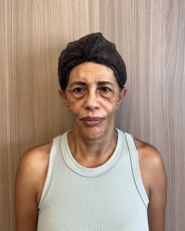 Antes — Blefaroplastia