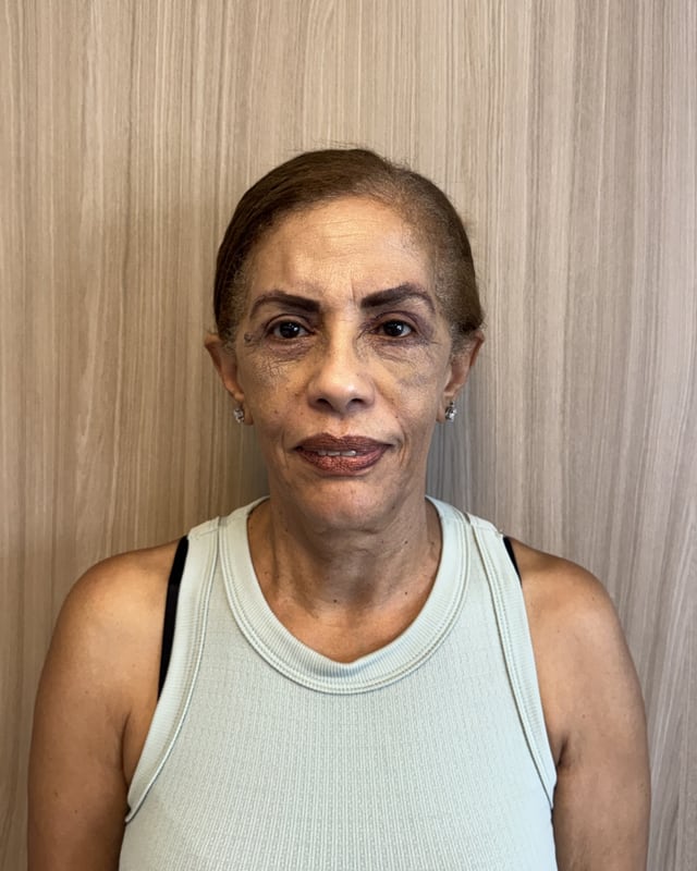 Depois — Blefaroplastia