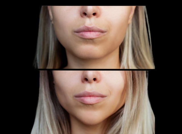 Procedimento de Bichectomia