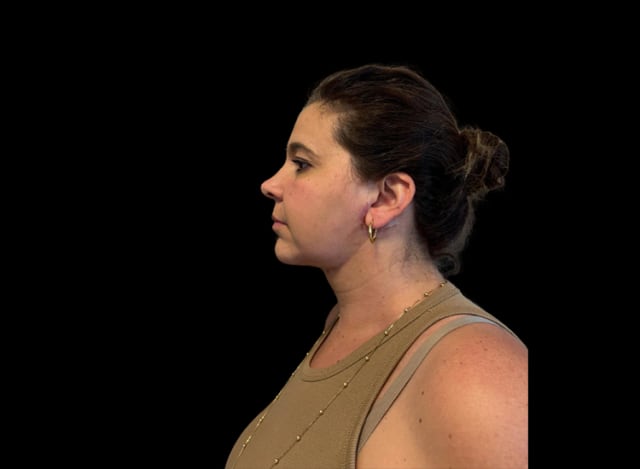 Procedimento de Cervicoplastia