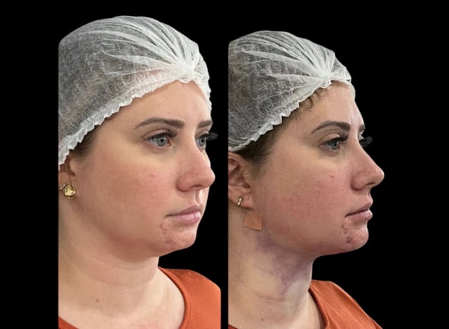 Procedimento de Lipo de Papada