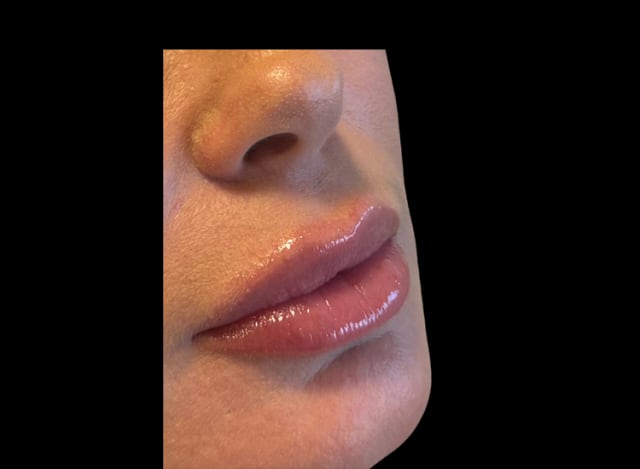 Procedimento de Preenchimento Labial