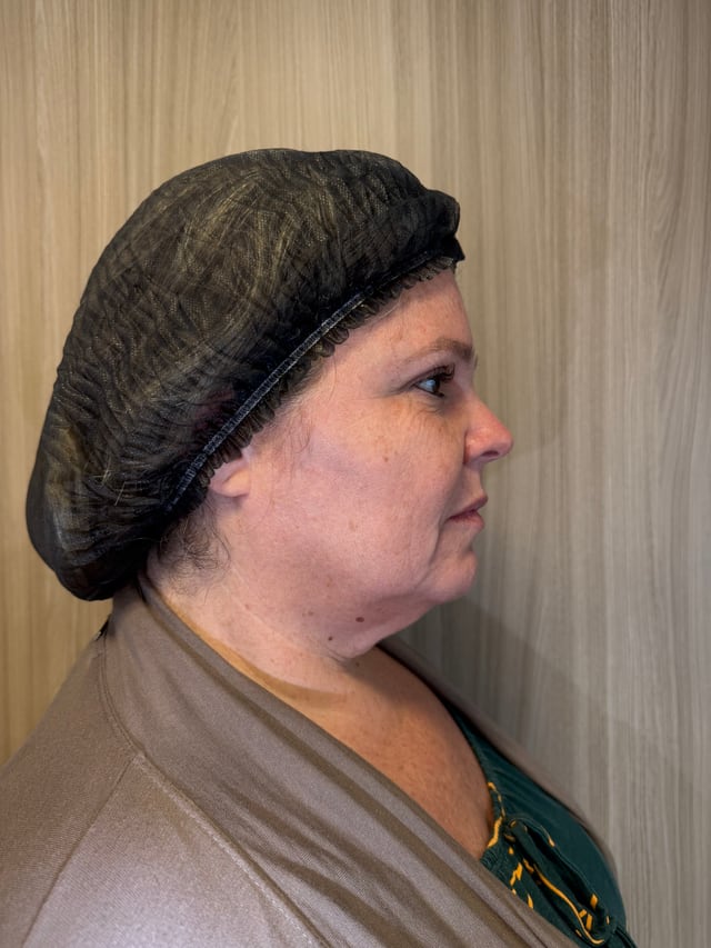 Antes — Cervicoplastia