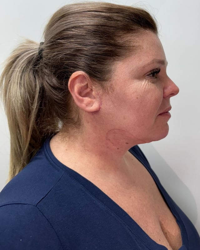 Depois — Cervicoplastia