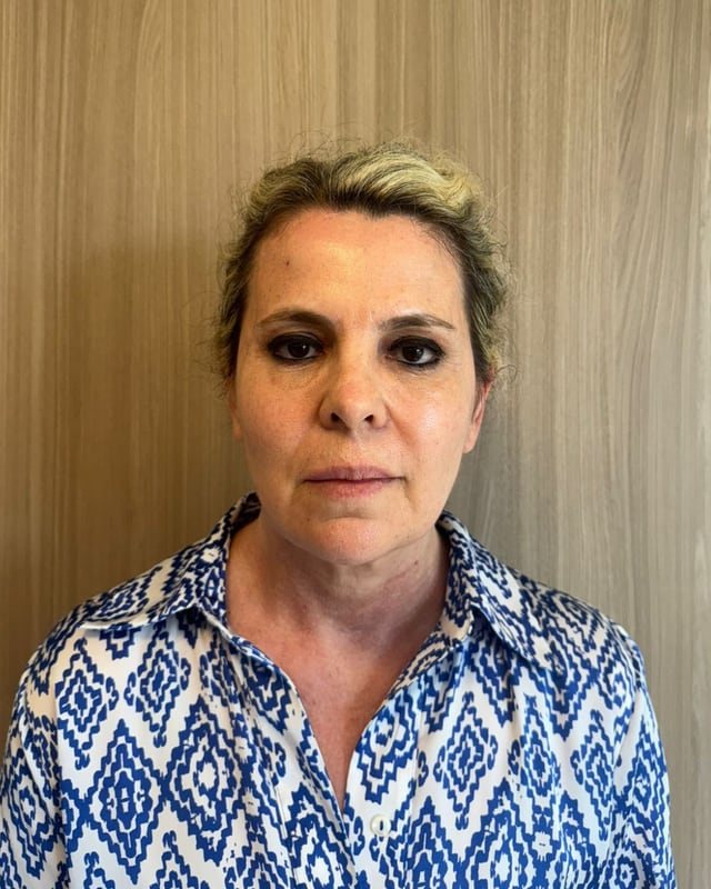 Antes — Embelezamento Facial