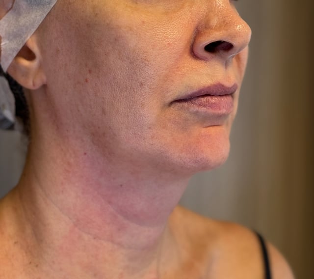 Antes — Platismoplastia