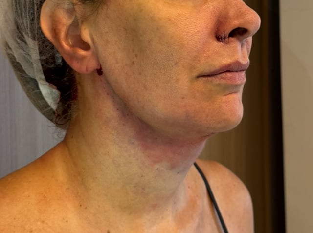 Depois — Platismoplastia