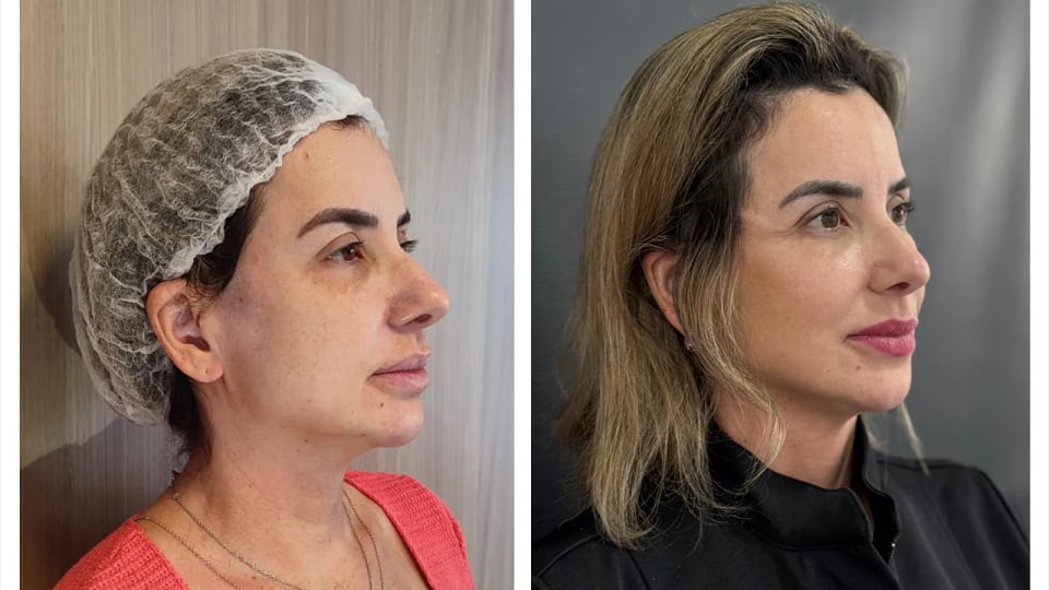 Antes e depois — Harmonização Orofacial
