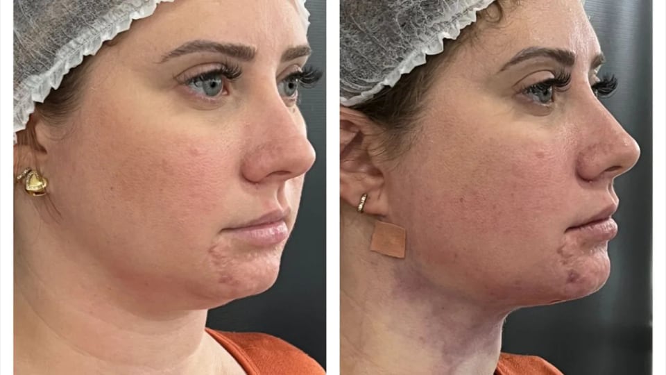 Antes e depois — Lipo de Papada