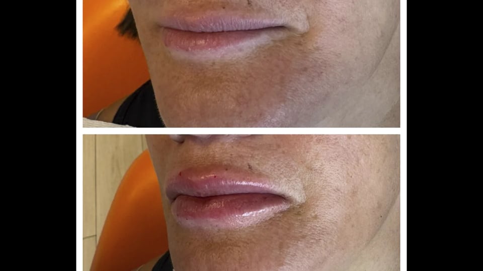 Antes e depois — Preenchimento Labial