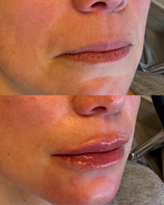 Antes e depois — Preenchimento Labial